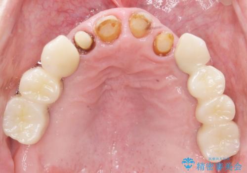 被せ物がとれたまま放置していた セラミックで綺麗に 50代男性の治療中