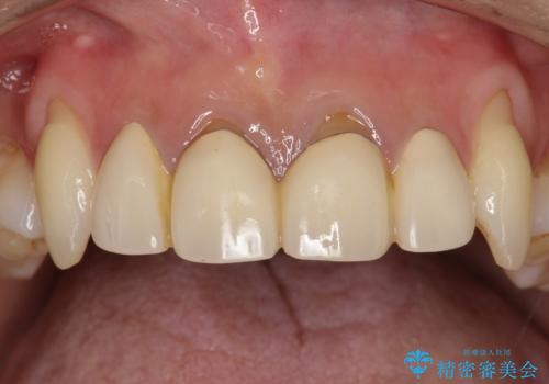 前歯のかぶせ物をオールセラミックへ　形を含めて理想の前歯への治療前