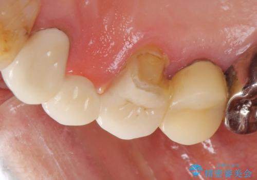被せ物がかけた 綺麗で丈夫なセラミックのブリッジへ 60代女性