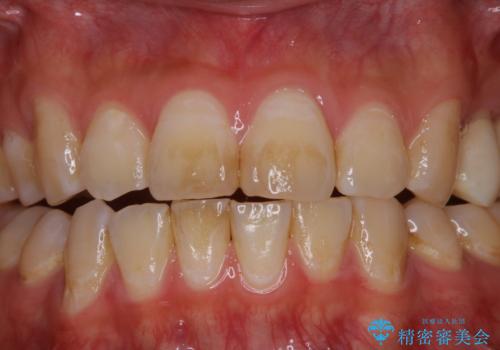 紅茶による着色を1日できれいにの治療前