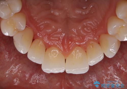 ホワイトニング前にPMTCの治療後