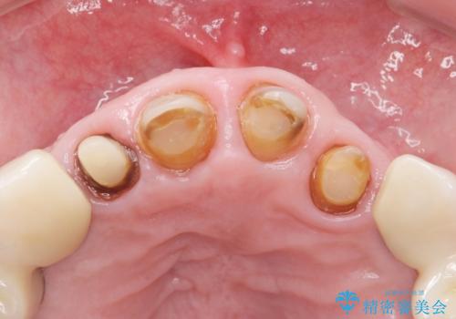 被せ物がとれたまま放置していた セラミックで綺麗に 50代男性の治療中