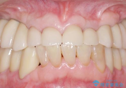 被せ物がとれたまま放置していた セラミックで綺麗に 50代男性の治療後