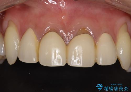 前歯のかぶせ物をオールセラミックへ　形を含めて理想の前歯への治療前