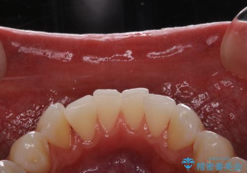 ホワイトニング前にPMTCの治療後