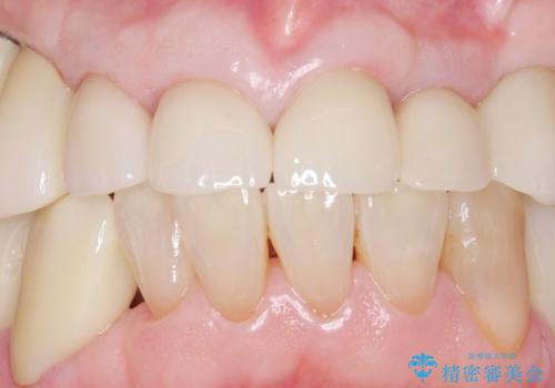 被せ物がとれたまま放置していた セラミックで綺麗に 50代男性の治療後