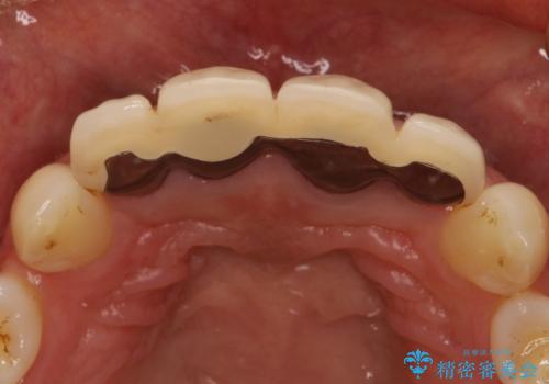 前歯のかぶせ物をオールセラミックへ 形を含めて理想の前歯への治療前