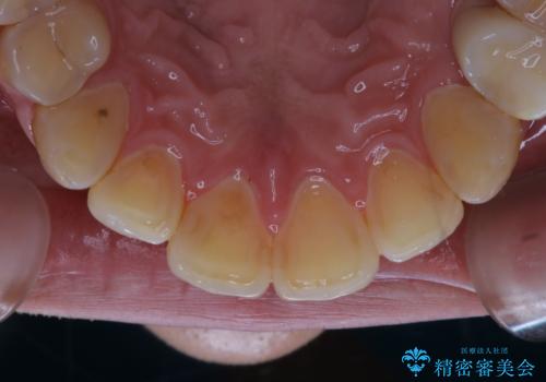 紅茶による着色を1日できれいにの治療前