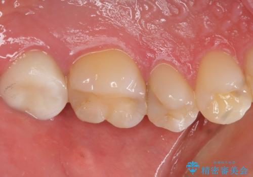 憧れの芸能人のような白い歯に 30代男性の治療前