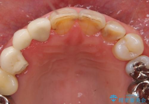 被せ物がかけた 綺麗で丈夫なセラミックのブリッジへ 60代女性の治療前