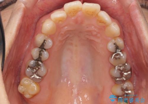 歯ぐきを押すと痛い 神経が死んでいる歯の治療 40代女性の治療前