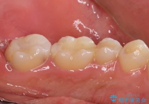 憧れの芸能人のような白い歯に 30代男性の治療前