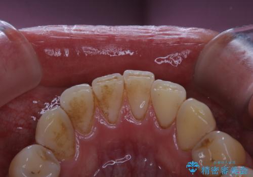 紅茶による着色を1日できれいにの治療前