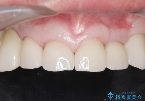 被せ物がとれたまま放置していた セラミックで綺麗に 50代男性の症例 治療後