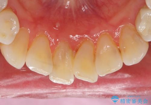 被せ物がかけた 綺麗で丈夫なセラミックのブリッジへ 60代女性の治療前