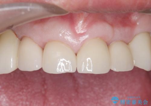 被せ物がとれたまま放置していた セラミックで綺麗に 50代男性の治療後