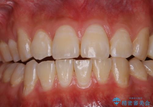 紅茶による着色を1日できれいにの治療後