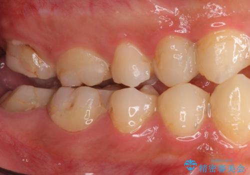 憧れの芸能人のような白い歯に 30代男性の治療前