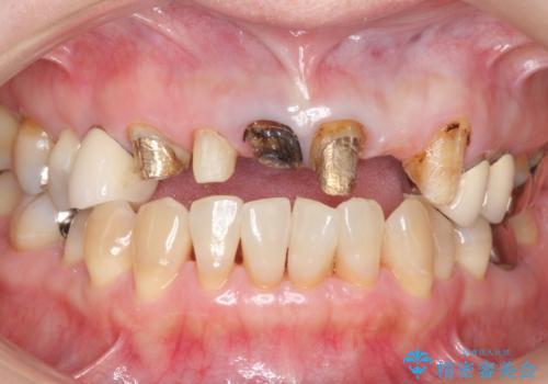 前歯のブリッジの下が虫歯 ブリッジのやりかえの治療中