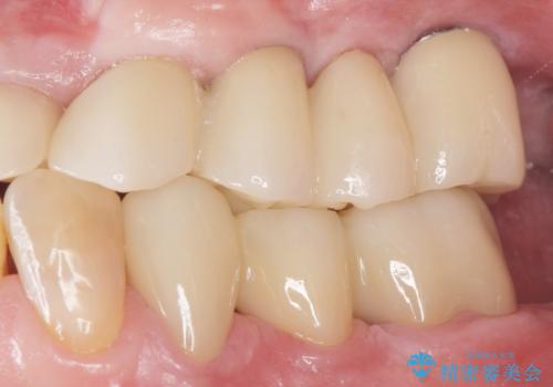 他院でインプラントできないと言われた 上顎洞底挙上術を併用したインプラント 50代男性の治療後