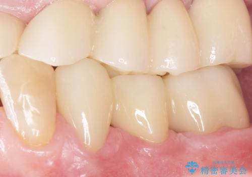 歯周病を治す 再生療法 50代男性の治療後