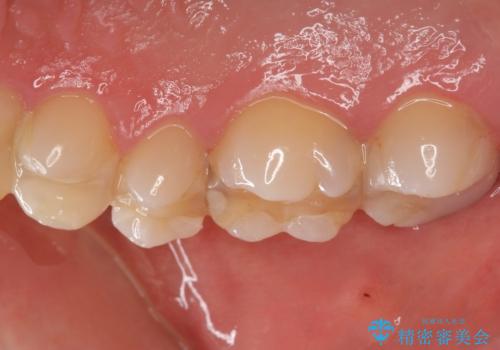 憧れの芸能人のような白い歯に 30代男性の治療前