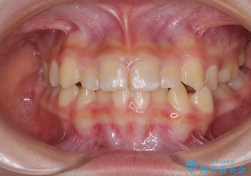 遠方から新幹線で通院 急速拡大装置とインビザラインによる矯正治療の治療前