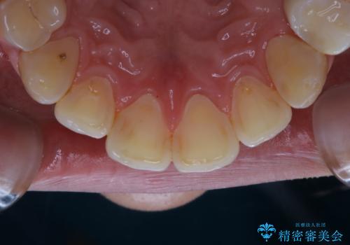 紅茶による着色を1日できれいにの治療後