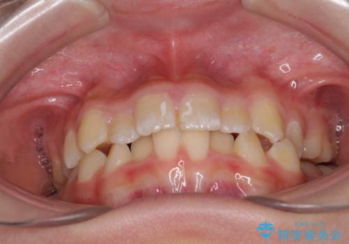 遠方から新幹線で通院 急速拡大装置とインビザラインによる矯正治療の治療前