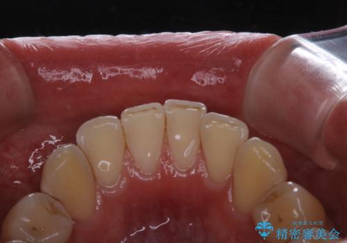 紅茶による着色を1日できれいにの治療後