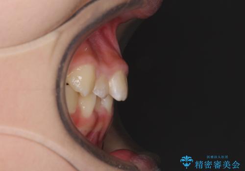 遠方から新幹線で通院 急速拡大装置とインビザラインによる矯正治療の治療前