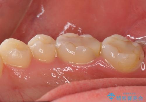 憧れの芸能人のような白い歯に 30代男性の治療前