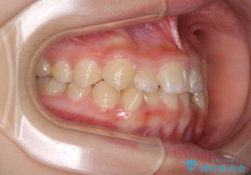 遠方から新幹線で通院 急速拡大装置とインビザラインによる矯正治療の治療前