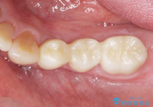 歯周病を治す 再生療法 50代男性の治療後