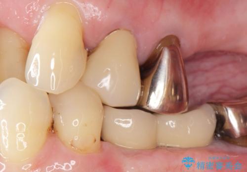 奥歯の違和感 再根管治療 40代女性の症例 治療前