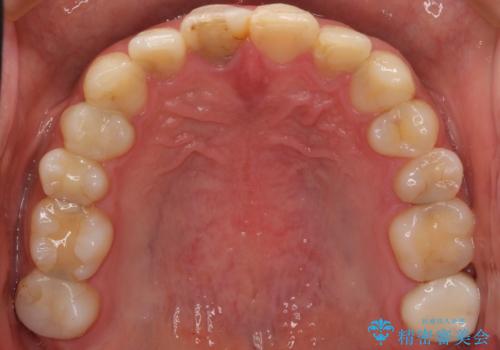 憧れの芸能人のような白い歯に 30代男性の治療前