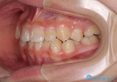 遠方から新幹線で通院 急速拡大装置とインビザラインによる矯正治療の治療前