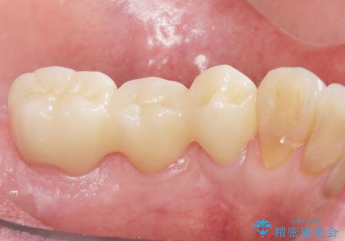 歯周病を治す 再生療法 50代男性の症例 治療後