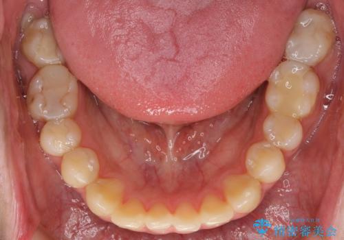 憧れの芸能人のような白い歯に 30代男性の治療前
