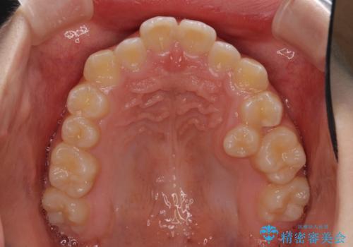 遠方から新幹線で通院 急速拡大装置とインビザラインによる矯正治療の治療前