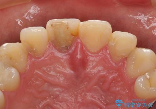 憧れの芸能人のような白い歯に 30代男性の治療前