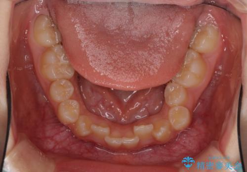 遠方から新幹線で通院 急速拡大装置とインビザラインによる矯正治療の治療前