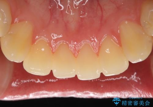憧れの芸能人のような白い歯に 30代男性の治療前