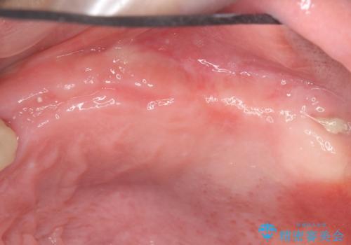 他院でインプラントできないと言われた 上顎洞底挙上術を併用したインプラント 50代男性の治療中