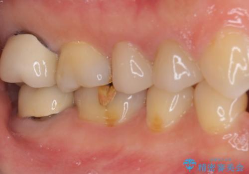強い咬み合わせでむし歯が悪化 ゴールドインレーによるむし歯治療の治療前