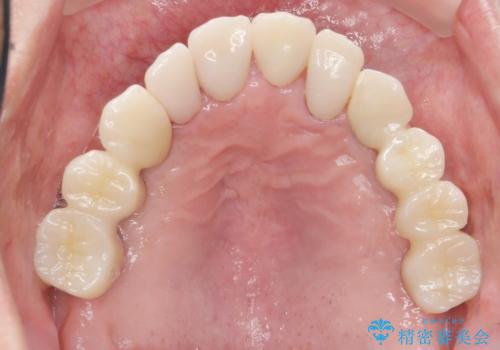 他院でインプラントできないと言われた 上顎洞底挙上術を併用したインプラント 50代男性の治療後