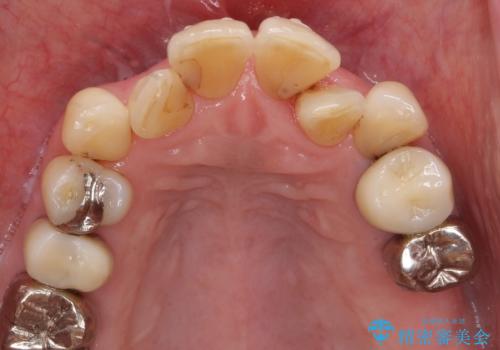 奥歯の違和感　再根管治療　40代女性の治療前