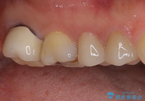 強い咬み合わせでむし歯が悪化　ゴールドインレーによるむし歯治療の治療前