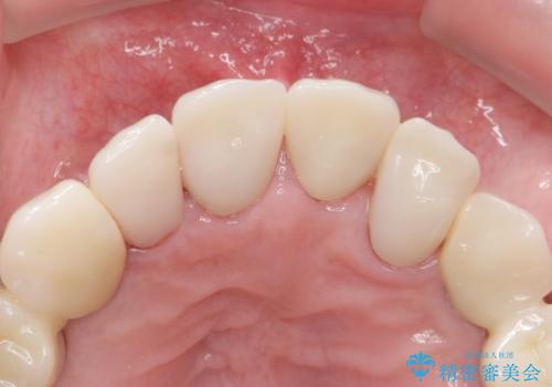 被せ物がとれたまま放置していた セラミックで綺麗に 50代男性の治療後