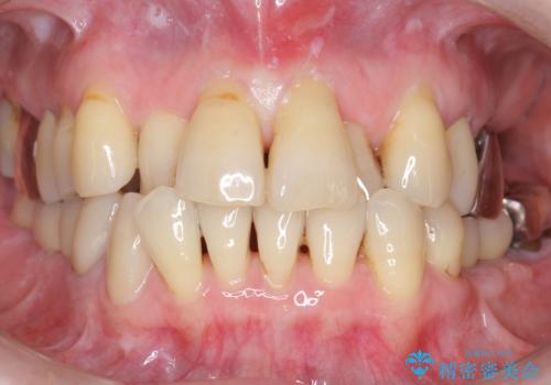 奥歯の違和感 再根管治療 40代女性の治療前
